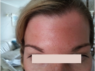 botox Plymouth Devon