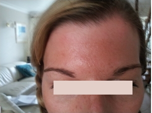 botox Plymouth Devon