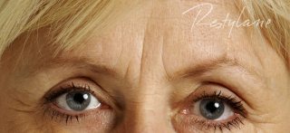 dermal fillers Plymouth Devon