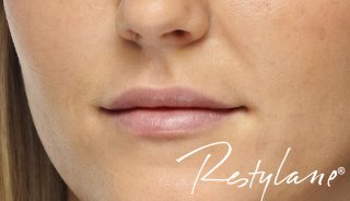 dermal fillers Plymouth Devon