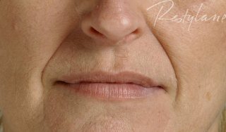 dermal fillers Plymouth Devon