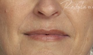 dermal fillers Plymouth Devon