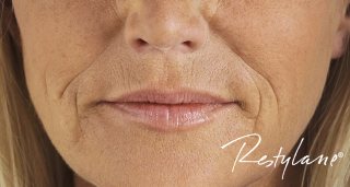 dermal fillers Plymouth Devon