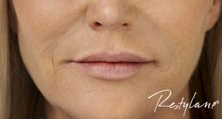 dermal fillers Plymouth Devon